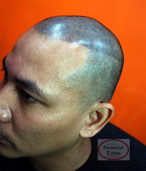 scalp tattoo manila philippines|Scalp Micropigmentation (Make Your Hair Look Fuller) .